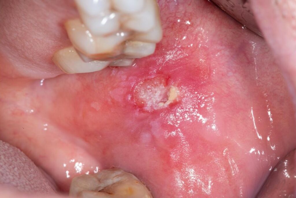 Leucoplasia oral diagnosticada mediante biopsia clínica